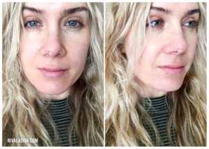Let's Talk: Skin Cancer