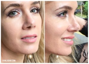 Let's Talk: Skin Cancer