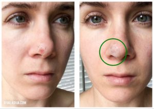 Let's Talk: Skin Cancer