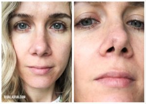 Let's Talk: Skin Cancer
