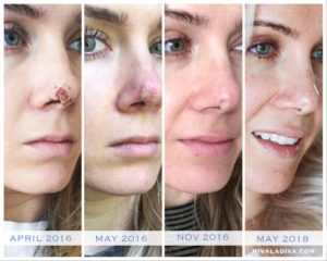 SKIN CANCER: 3 things I wish I knew