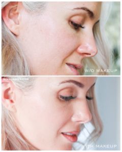 SKIN CANCER: 3 things I wish I knew